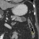 Cystic tumour of pancreas, pancreatic tail: CT - Computed tomography